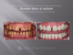 Bruxism diurn si nocturn